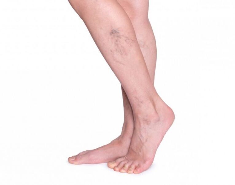 Varicose veins before the treatment varicone