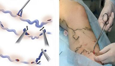 Flebectomy for varicose veins on the legs