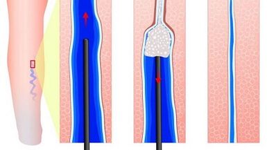 Sclerotherapy for varicose veins