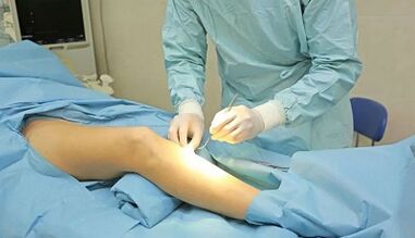 How an operation with varicose veins is performed