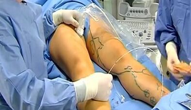 Operation for varicose veins
