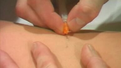 Methods of varicose veins of the lower ends