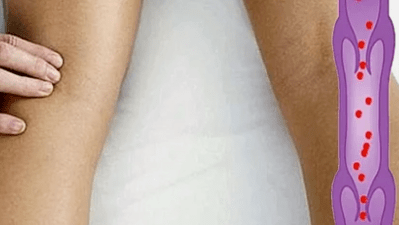 The reasons for the development of the varicose veins of the lower ends