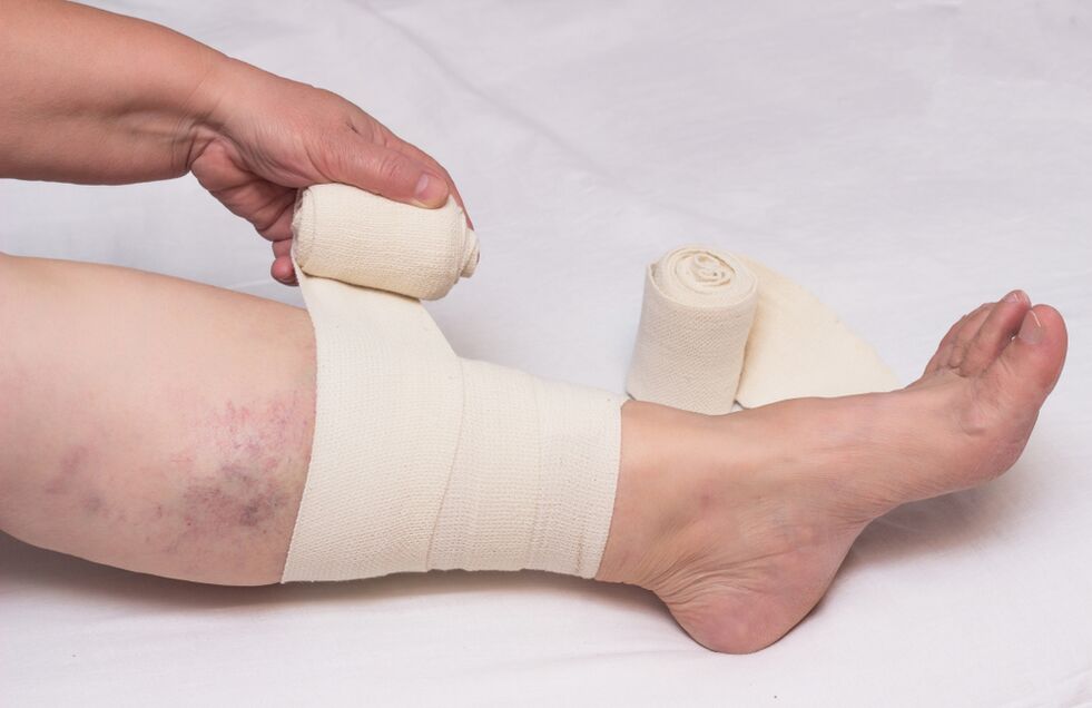 Compression treatment of varicose veins